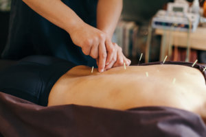 Acupuncture in Midtown NYC