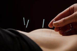 Acupuncture for Treating General Pain