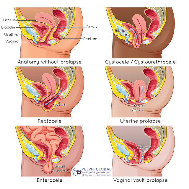 Pelvic Organ Prolapse (POP)  Southern Urogynecology Wellness & Aesthetics